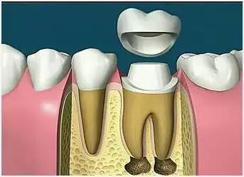 牙齿修复是什么意思