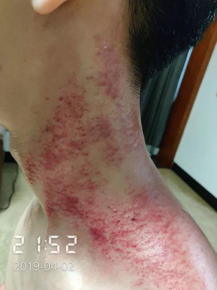 舌苔提示心肝火旺,曲池,劳宫降心火,太溪,复溜补肾水;风邪为阳邪侵犯