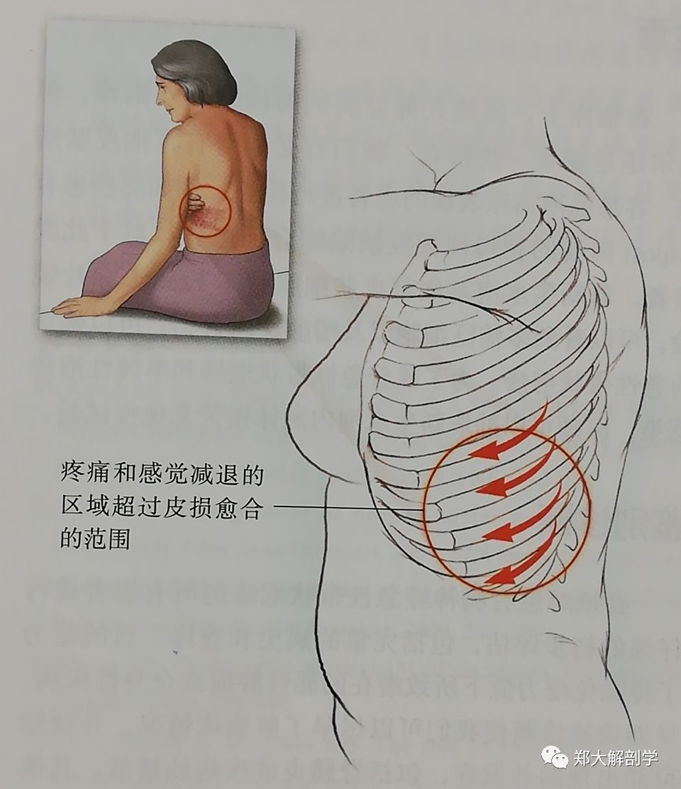 四种引起胸椎的疼痛综合征