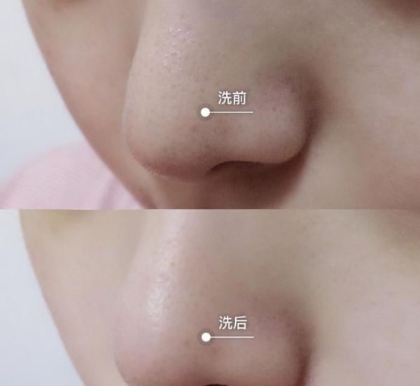 啥是黑头闭口 f9de315dd143473bbf1106c41938104c.jpeg