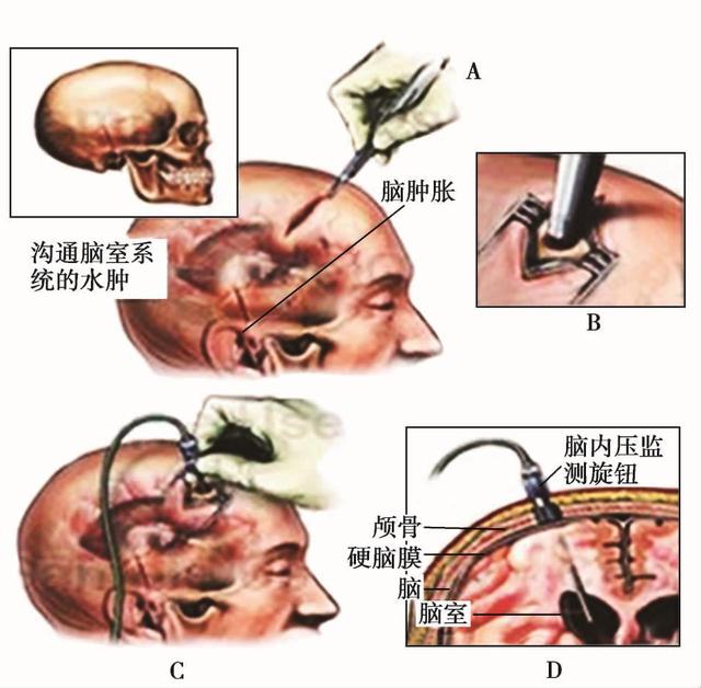 颅内压监测的方法之有创icp监测