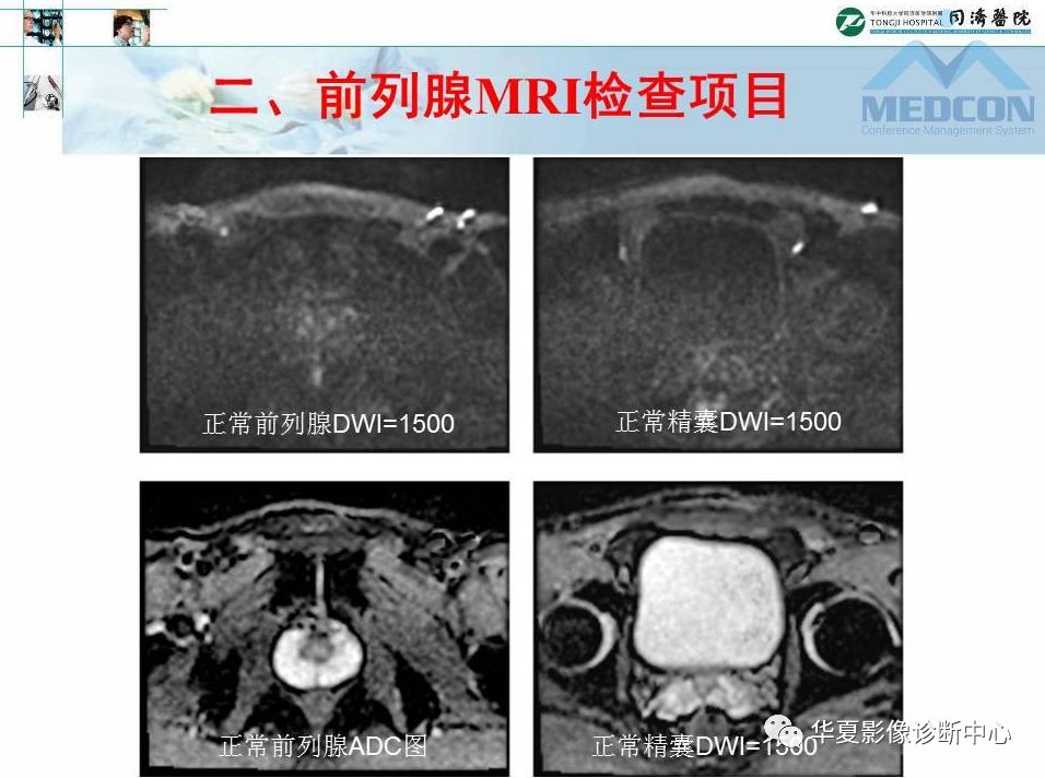 规范前列腺mri扫描技术,让诊断变得没那么难