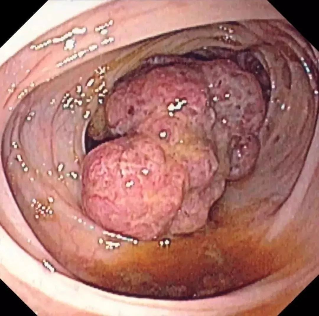 大肠癌在世界范围内属于第三大恶性肿瘤,在我国一些大城市,如沪,广,深