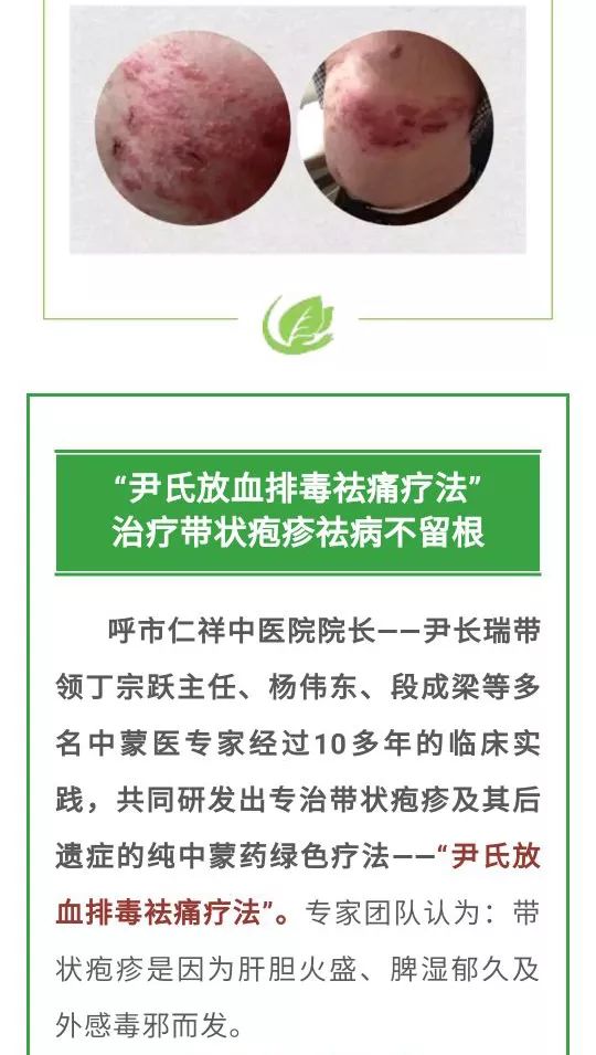 带状疱疹后遗症疼的厉害怎么办?有一种中蒙医疗法助您