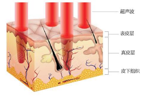 美容超声刀原理是什么_白带是什么图片(2)