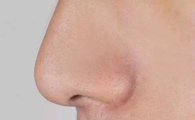 鼻孔内壁为什么有白点