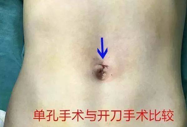 小切口、大手术 ---介绍中山市人民医院普外四科单孔法治疗小儿疝气