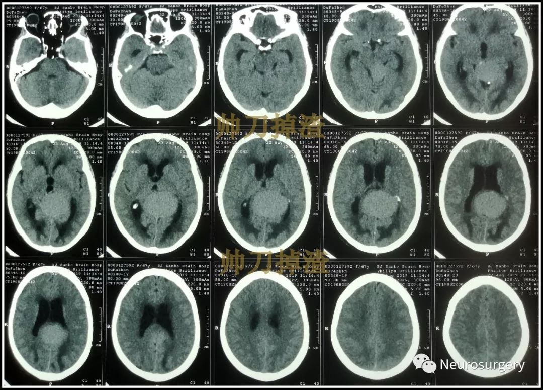 【帅刀掉渣】病例分析:小脑幕切迹型脑膜瘤的手术及解剖