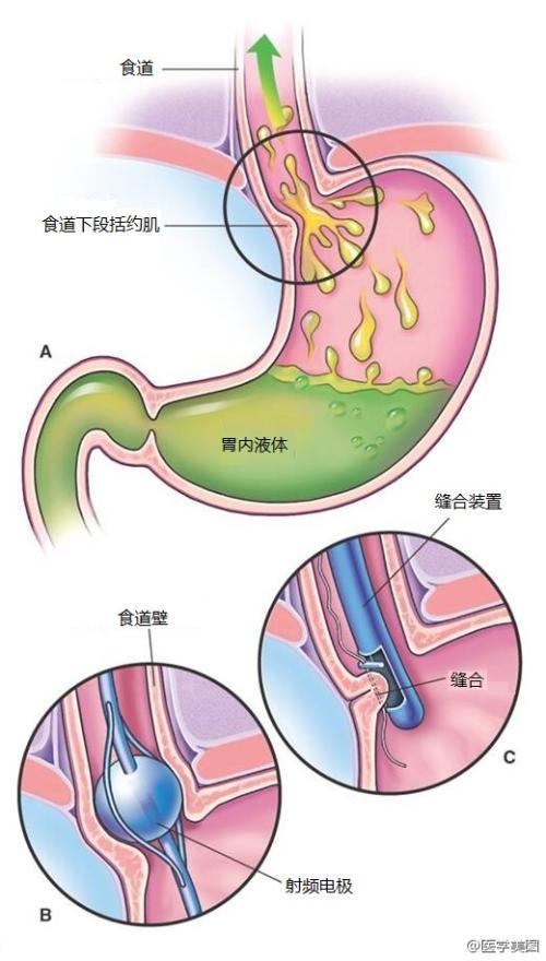 胃食管反流病的内镜下治疗的方法