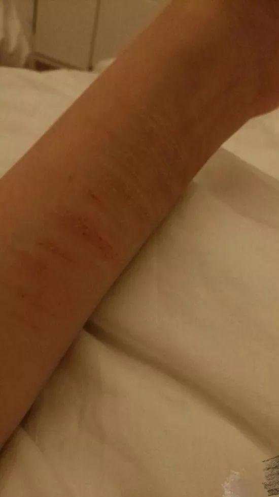 微博中配了手腕有伤痕的照片.