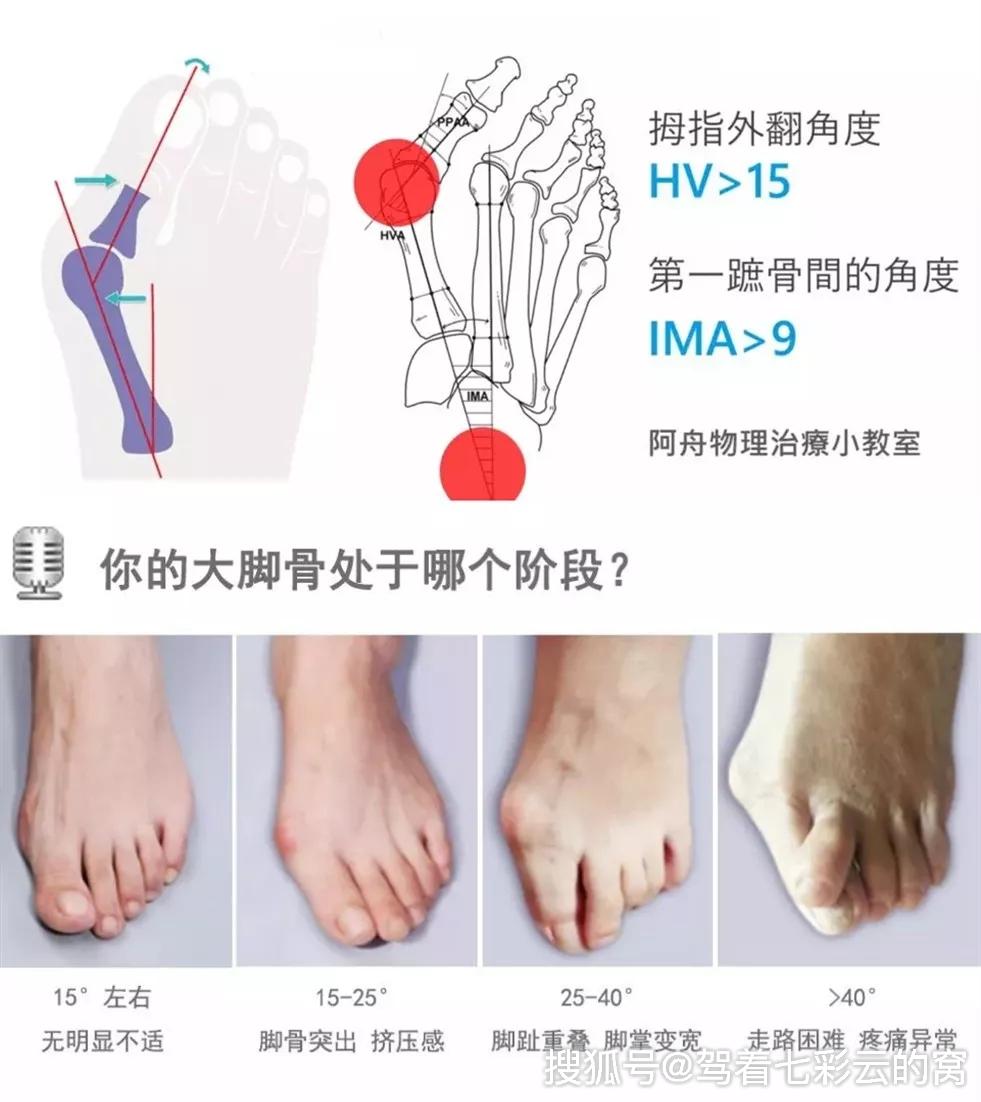 大脚骨按照大拇指外翻的角度可以分为四个等级,当拇指骨和第一趾骨