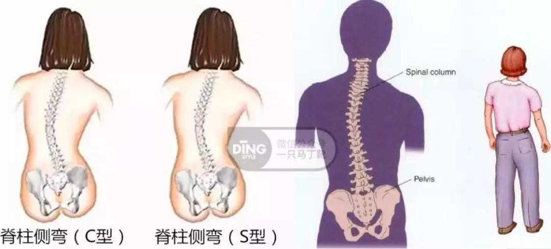 这时候骨盆都是倾斜的,脊柱也会发生弯曲