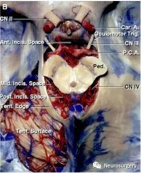 【帅刀掉渣】病例分析:小脑幕切迹型脑膜瘤的手术及解剖