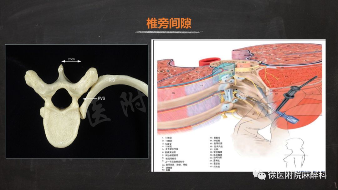 超声引导下胸椎旁神经阻滞的临床应用