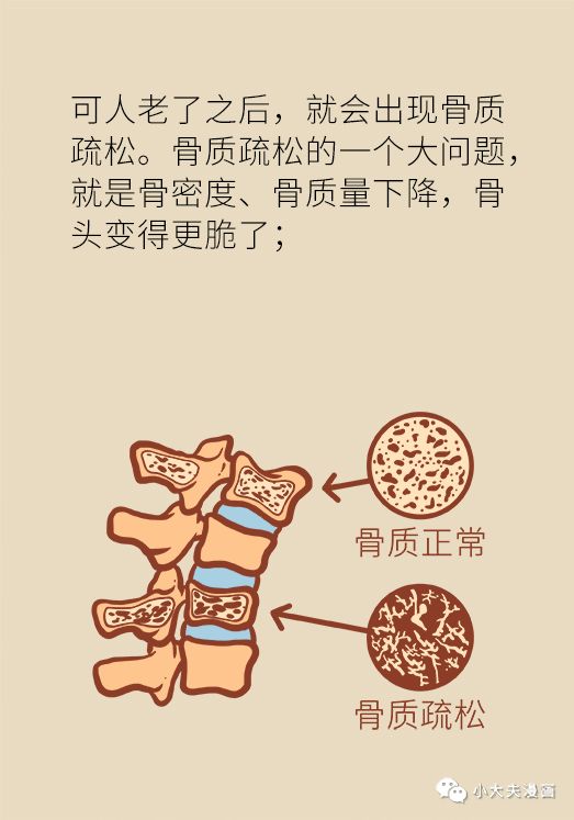 多少岁开始补钙预防骨质疏松 6407e05bbe5b45e9a6e2d0aecc8154a6.jpeg