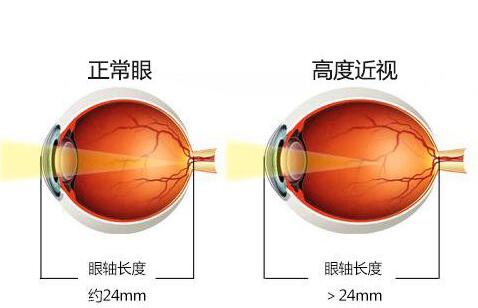 青岛一夜:女白领高度近视2000多度手术记录全过程