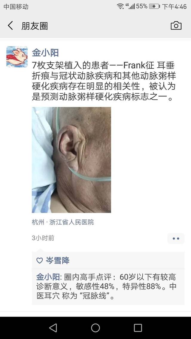 耳垂折痕预示冠心病?这不是谣言!