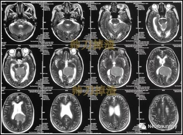 【帅刀掉渣】病例分析:小脑幕切迹型脑膜瘤的手术及解剖