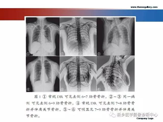 肋骨骨折