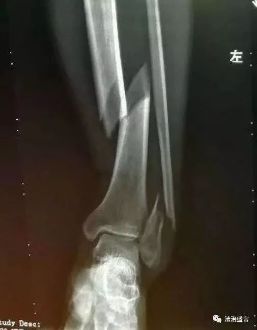 卢华生左腿共三处骨折，其中两处为螺旋形骨折，一处为后踝的竖向骨折。
