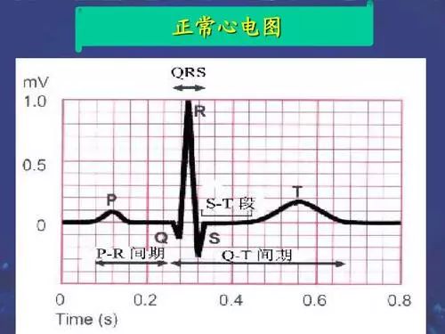 心电图t波倒置怎么办