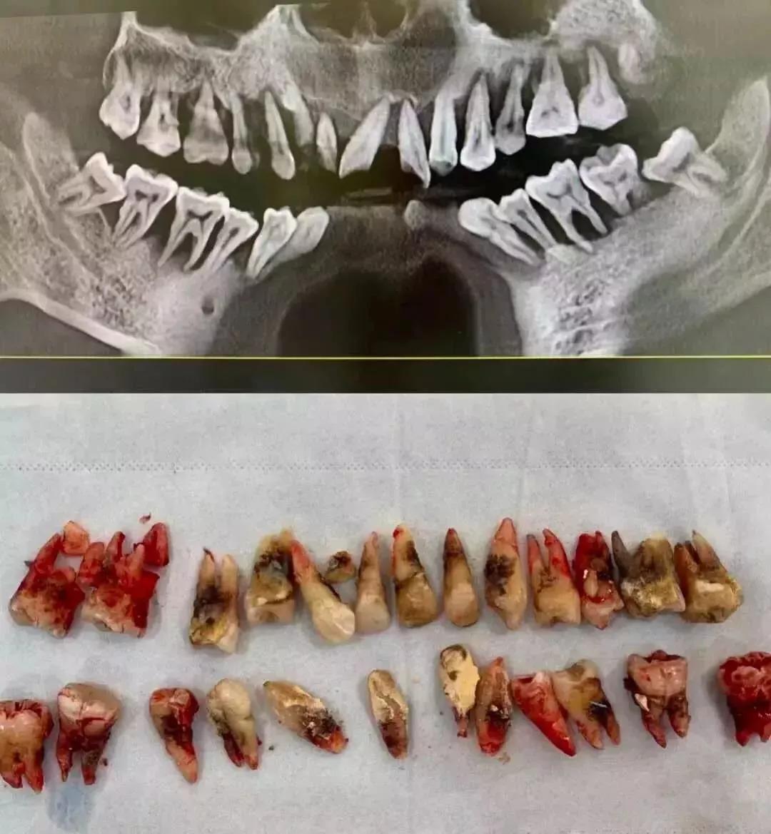 严重时牙龈会溢脓,牙龈退缩,牙槽骨吸收,牙缝慢慢变大,最后牙齿松动