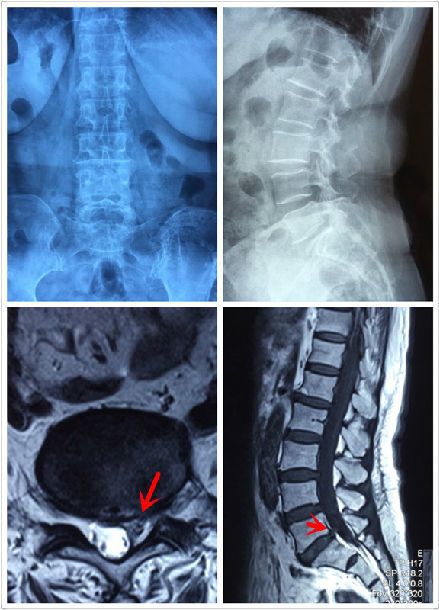 ct,mri可显示椎间盘突出的节段,大小,形态和神经根,硬脊膜囊受压程度