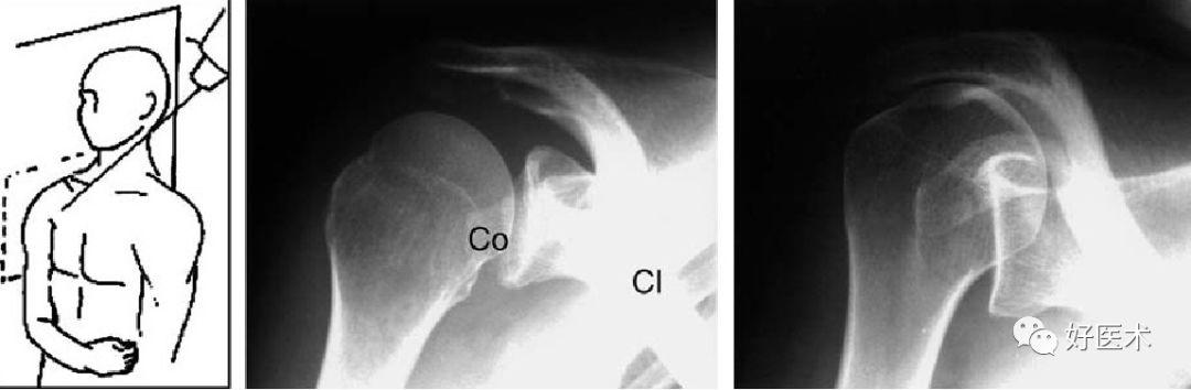 x线正切于"肩胛胸关节",并且可对肩峰下间隙进行较好的评估 出口位x线