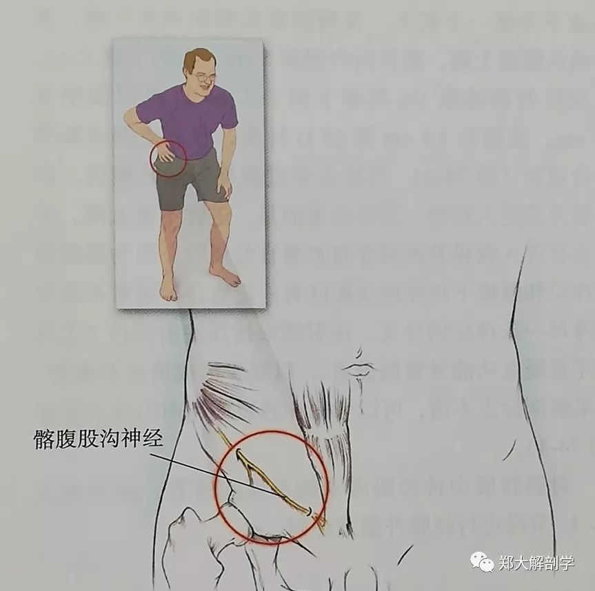 四种引起腹部和腹股沟疼痛综合征