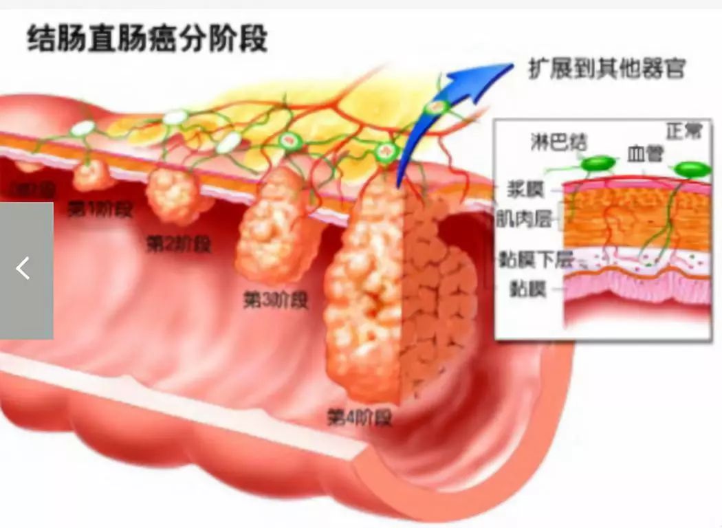 结直肠癌的来龙去脉