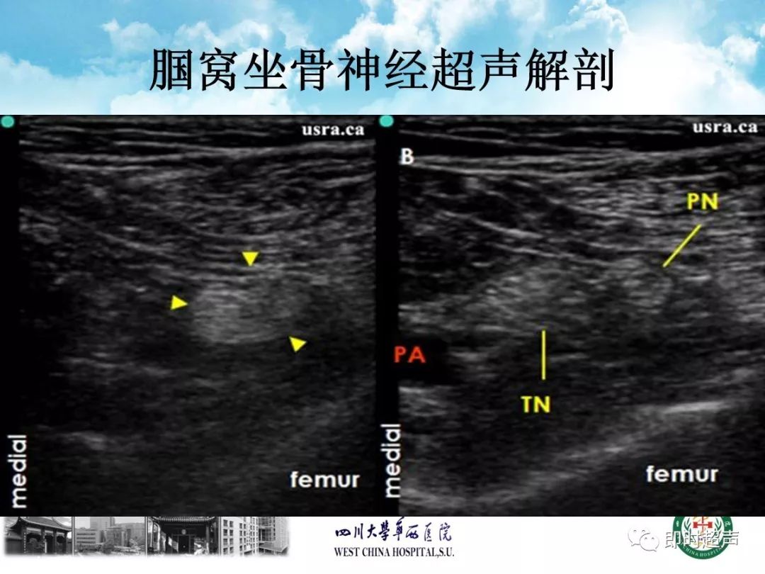 超声引导下股神经,坐骨神经阻滞