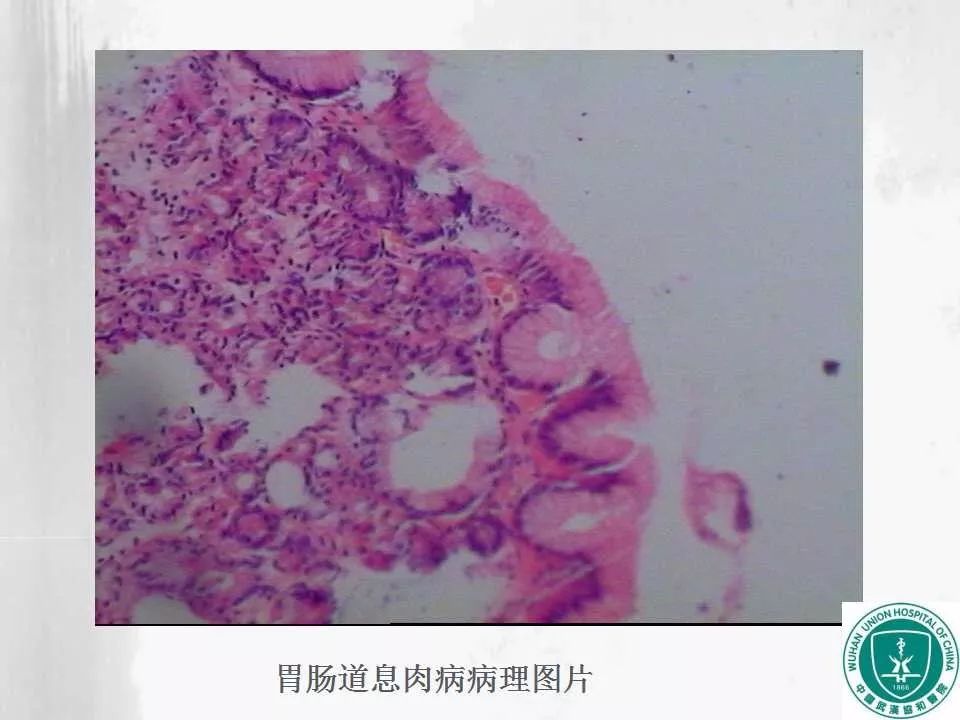息肉恶变x线表现为肿物较大,隆起边界 不规则,成分叶状,隆起病变表面