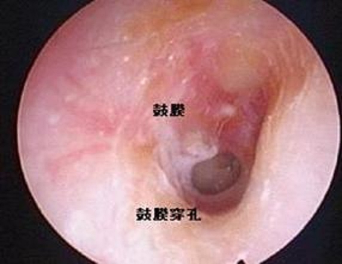 耳膜出现内陷的恢复方法