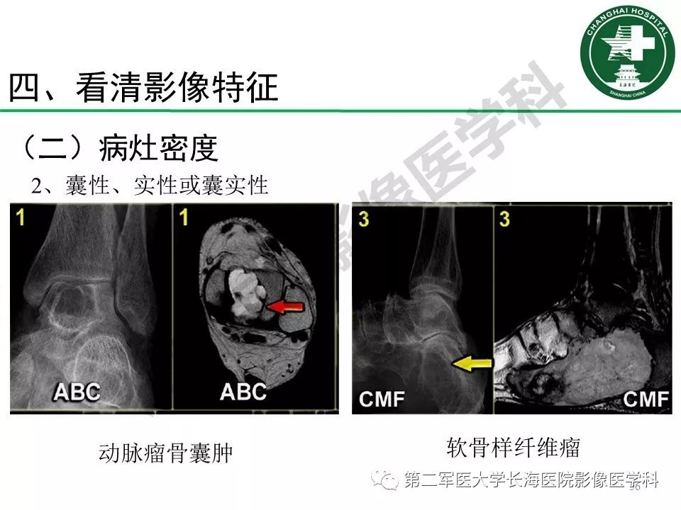 超级棒骨肿瘤鉴别诊断全攻略