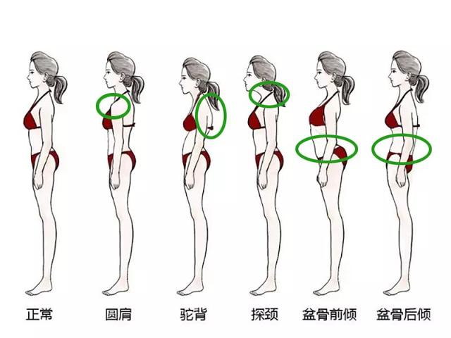 连唐嫣都有骨盆前倾,赶紧查查自己是否中招