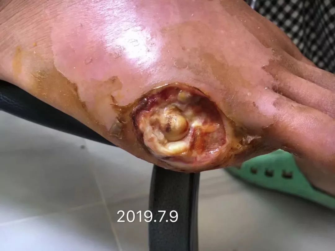 李氏砭法|虎符铜砭化腐肉为新生,让截肢溃烂的糖尿病足避免再次手术