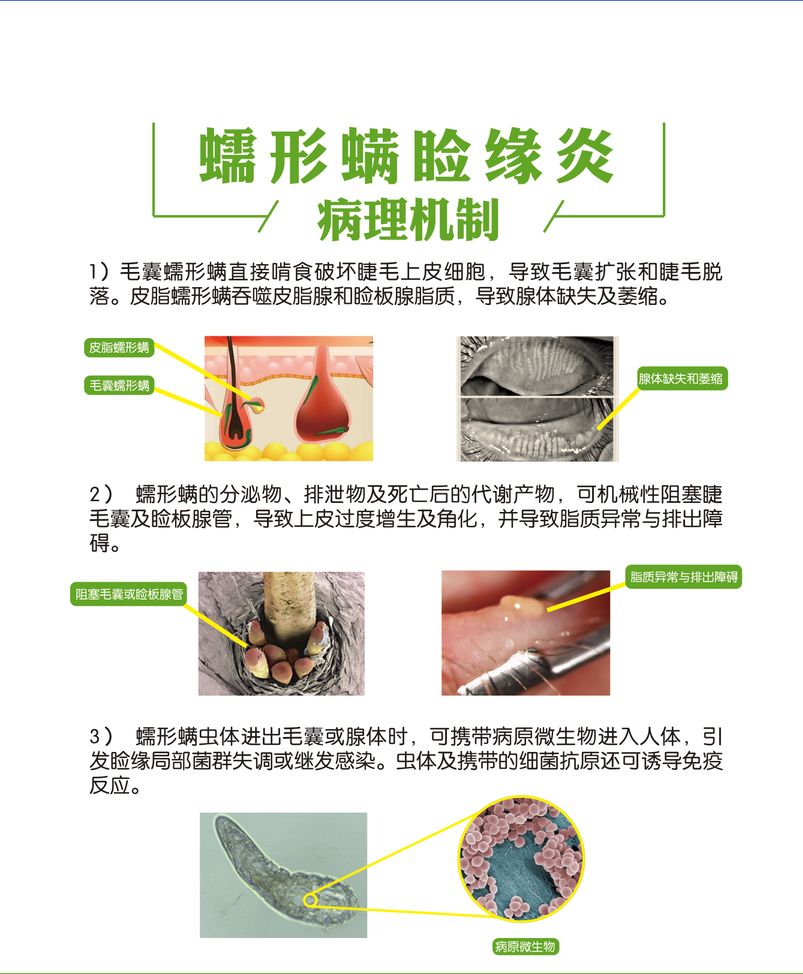 常见蠕形螨睑缘炎