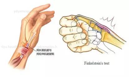 桡骨茎突狭窄性腱鞘炎是出现在腕部拇指一侧的骨突(桡骨茎突)处,表现