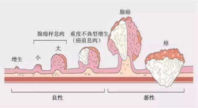 大肠息肉怎么办