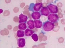 小淋巴是什么病 3bb2a72b60a7419f8167c6b26c7b0505.jpeg