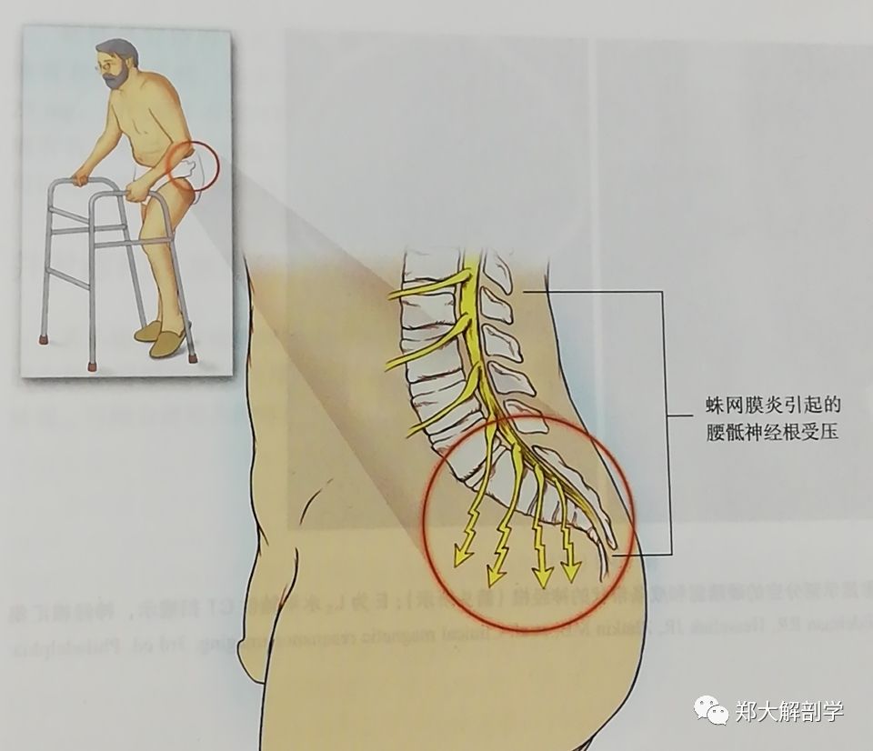 六种引起腰椎和骶髂关节的疼痛综合征