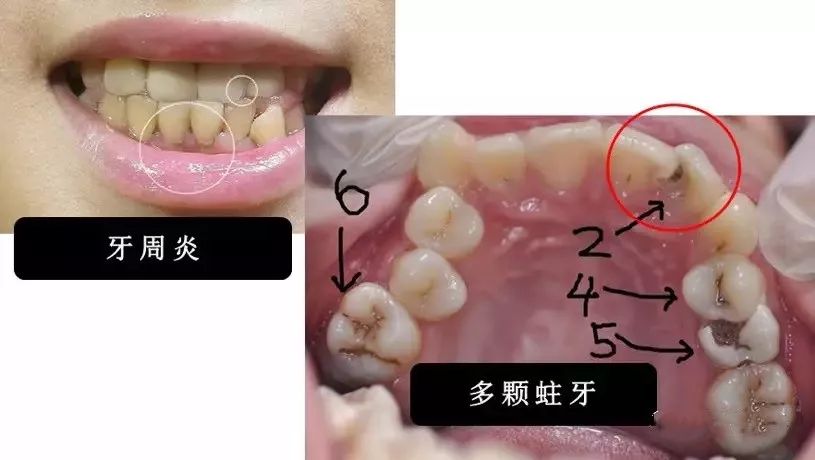 也就是俗称的龅牙,一旦受到外伤, 前门牙折断的几率是正常牙齿的三倍