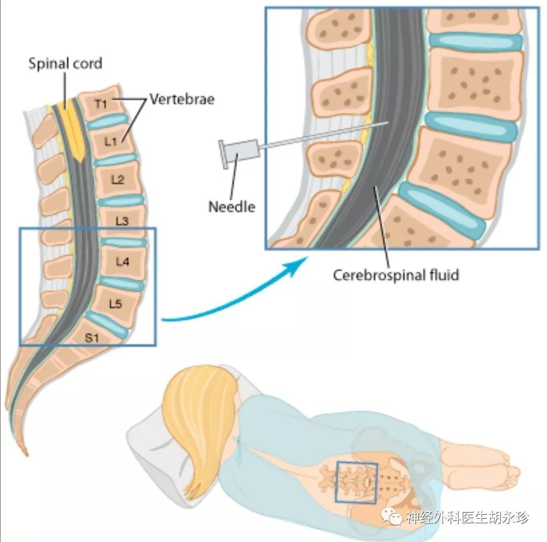 腰椎穿刺术我们为什么要做