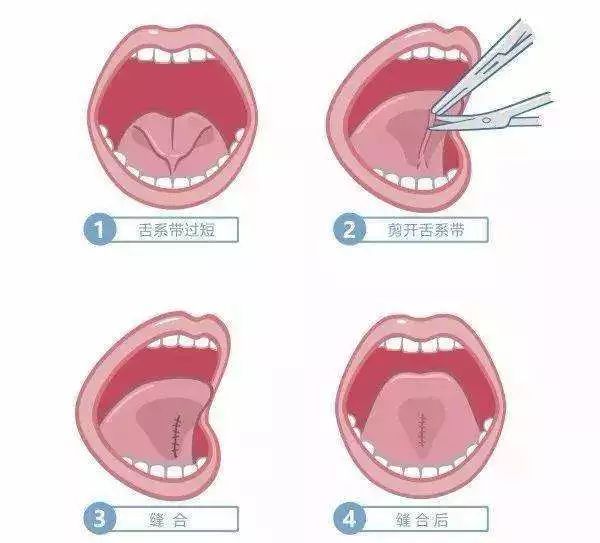 孩子话说不清楚,做这个小手术就能搞定?_舌头