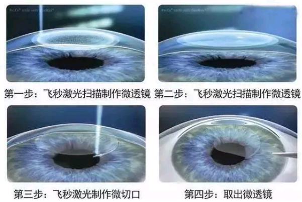 激光近视手术原理图解 c2ab72a24d404f4da542b9f04415aaca.png