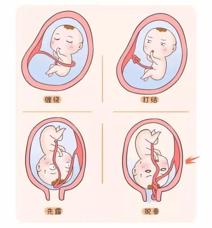 漫长的怀胎过程中,在妈妈肚子里无聊的宝宝,自然就"盯"上了脐带这唯一