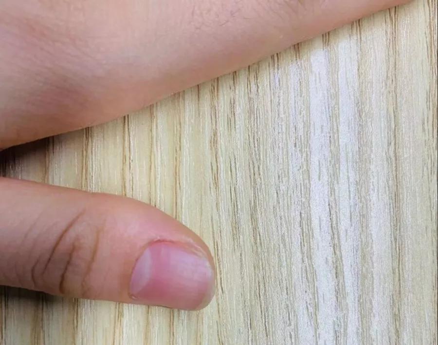 甲周皮肤出现黑斑而有的人因为 先天的甲母质比较靠后或 指甲的生长
