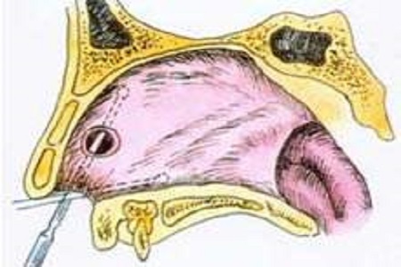 首大崔付军:造成鼻中隔溃疡原因有哪些