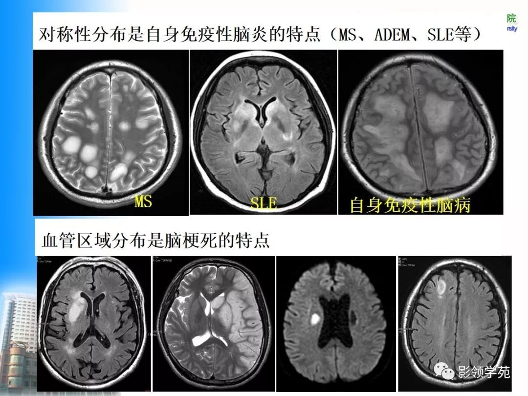 术后或医源性④病灶在脑内解剖分布:幕上,幕下;脑膜,灰质与白质免疫