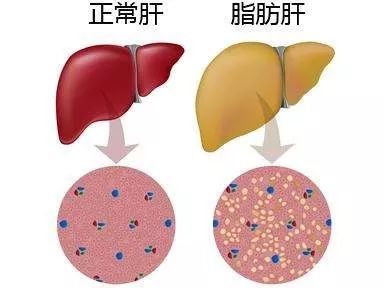 下面就带大家来了解一下脂肪肝!    脂肪肝是什么